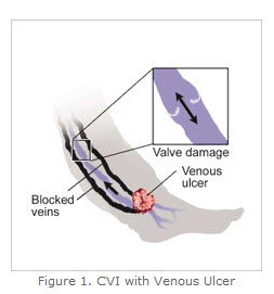 cvi with venus ulcer